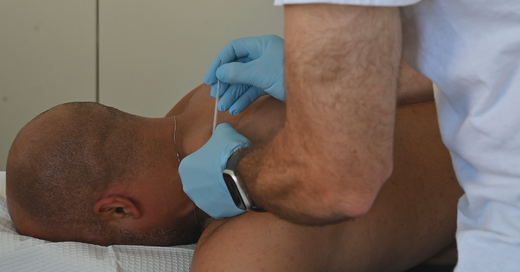 Dry Needling: What You Need to Know for Faster Muscle Healing